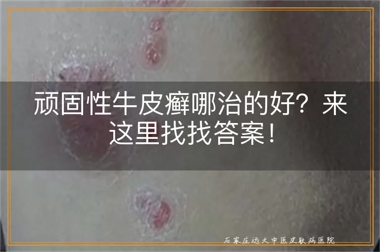 顽固性牛皮癣哪治的好？来这里找找答案！