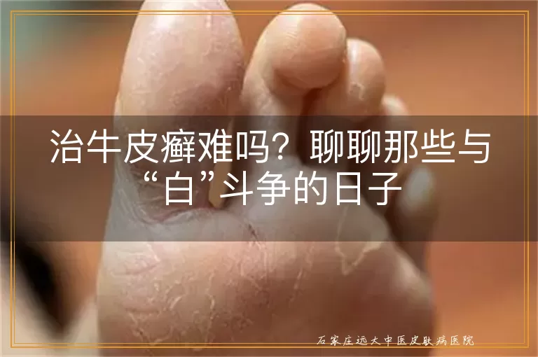 治牛皮癣难吗？聊聊那些与“白”斗争的日子