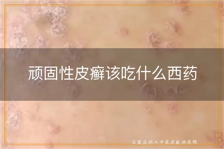 顽固性皮癣该吃什么西药