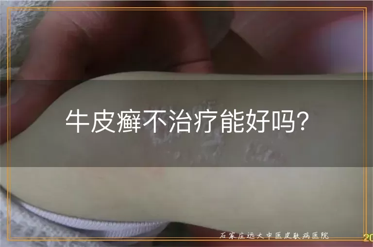 牛皮癣不治疗能好吗？