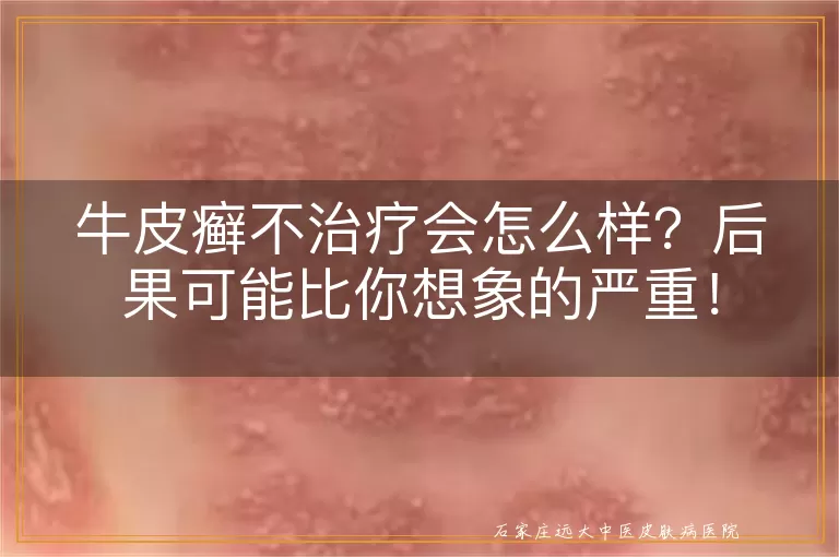 牛皮癣不治疗会怎么样？后果可能比你想象的严重！