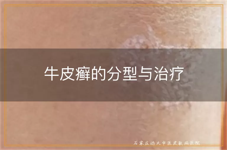 牛皮癣的分型与治疗