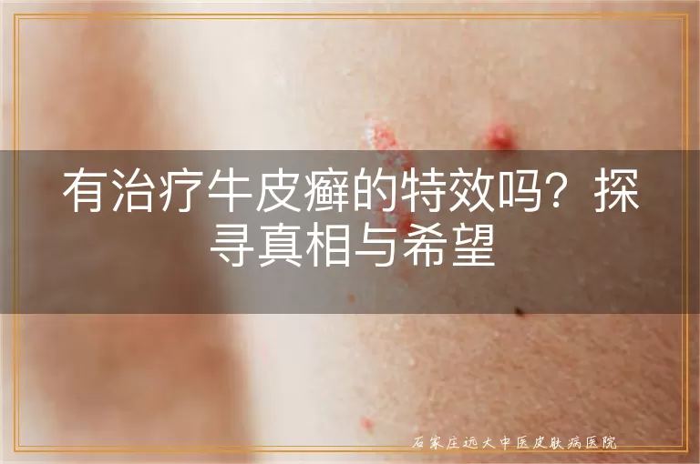 有治疗牛皮癣的特效吗？探寻真相与希望