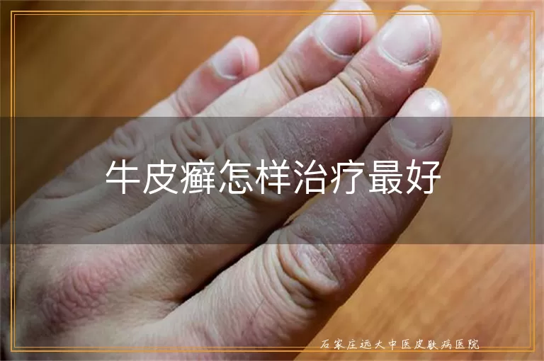 牛皮癣怎样治疗最好