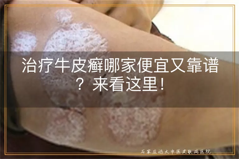 治疗牛皮癣哪家便宜又靠谱？来看这里！