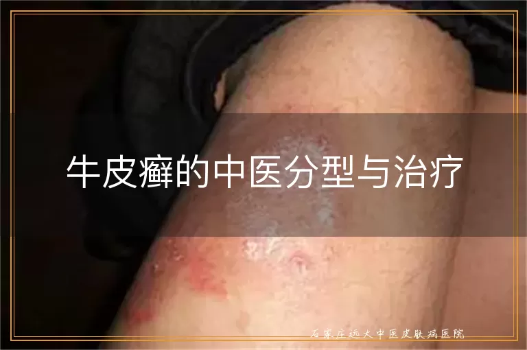 牛皮癣的中医分型与治疗