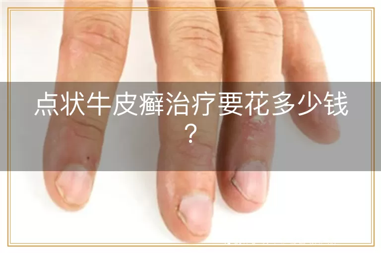 点状牛皮癣治疗要花多少钱？