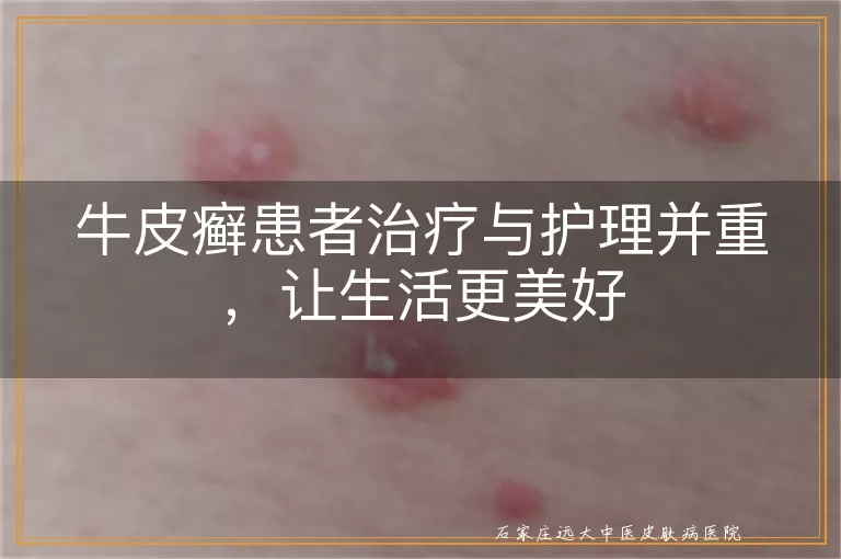 牛皮癣患者治疗与护理并重，让生活更美好