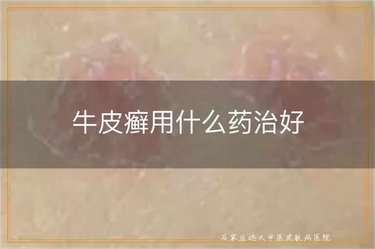 牛皮癣用什么药治好