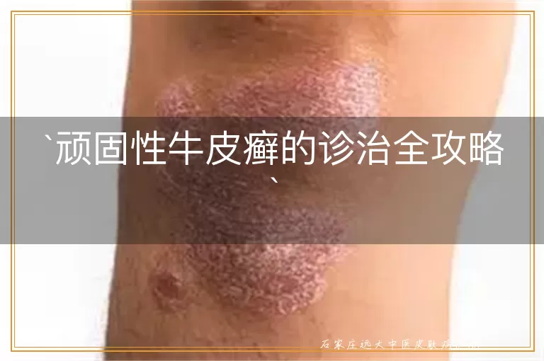 顽固性牛皮癣的诊治全攻略