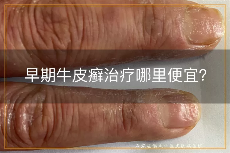 早期牛皮癣治疗哪里便宜？