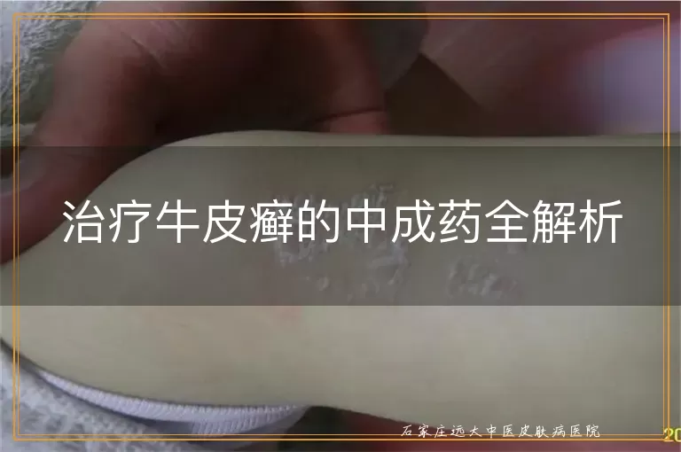 治疗牛皮癣的中成药全解析