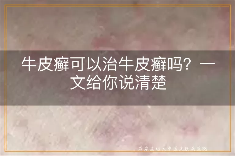 牛皮癣可以治牛皮癣吗？一文给你说清楚