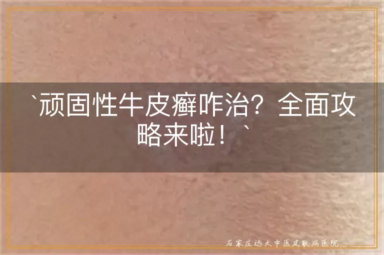 顽固性牛皮癣咋治？全面攻略来啦！