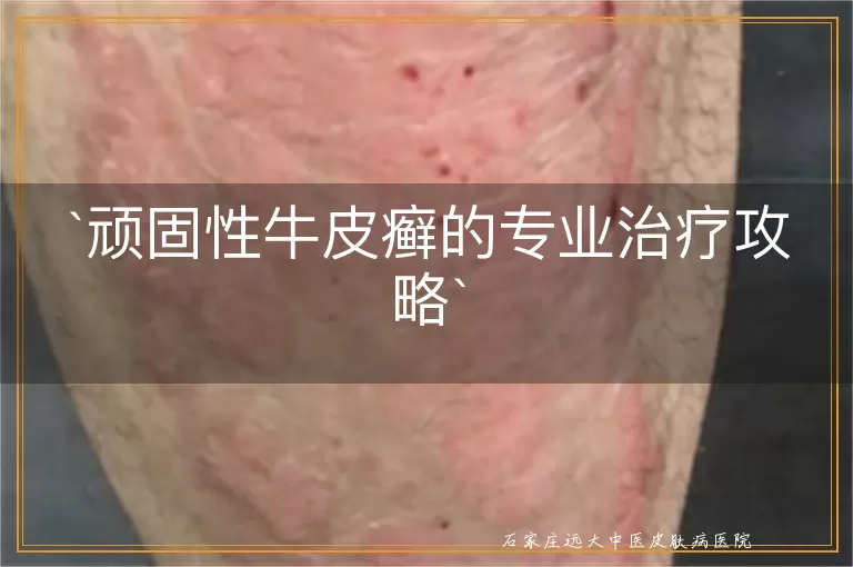 顽固性牛皮癣的专业治疗攻略