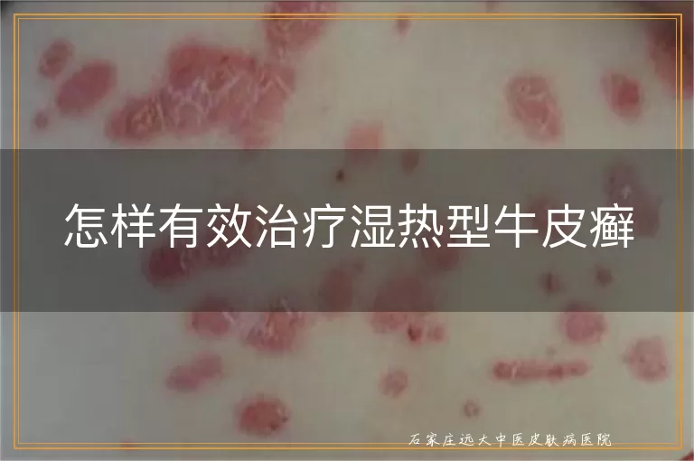 怎样有效治疗湿热型牛皮癣