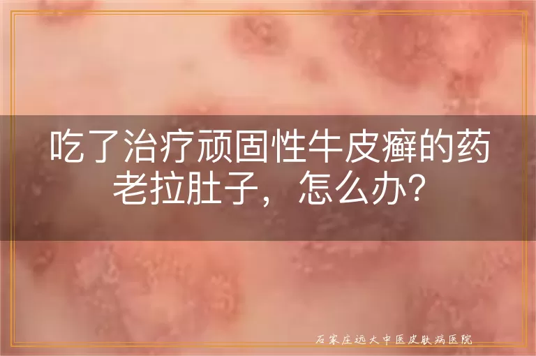 吃了治疗顽固性牛皮癣的药老拉肚子，怎么办？