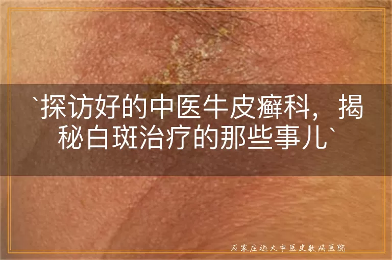 探访好的中医牛皮癣科，揭秘白斑治疗的那些事儿