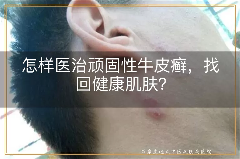 怎样医治顽固性牛皮癣，找回健康肌肤？