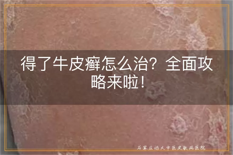 得了牛皮癣怎么治？全面攻略来啦！