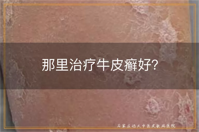 那里治疗牛皮癣好？