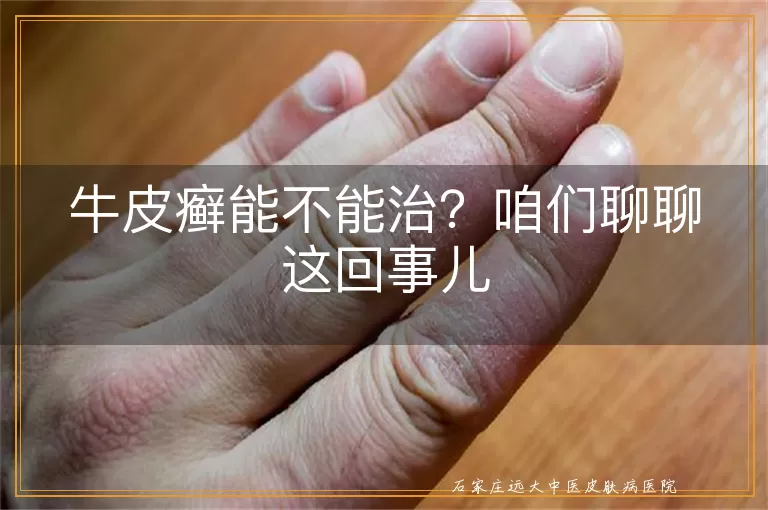 牛皮癣能不能治？咱们聊聊这回事儿