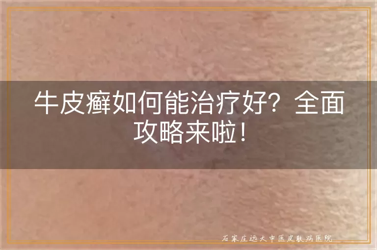 牛皮癣如何能治疗好？全面攻略来啦！