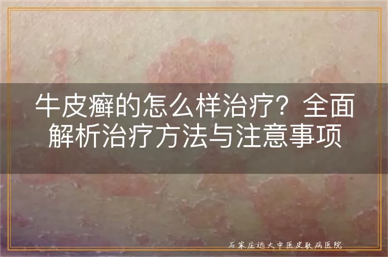 牛皮癣的怎么样治疗？全面解析治疗方法与注意事项