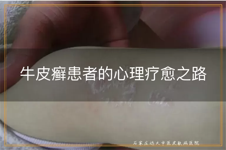 牛皮癣患者的心理疗愈之路