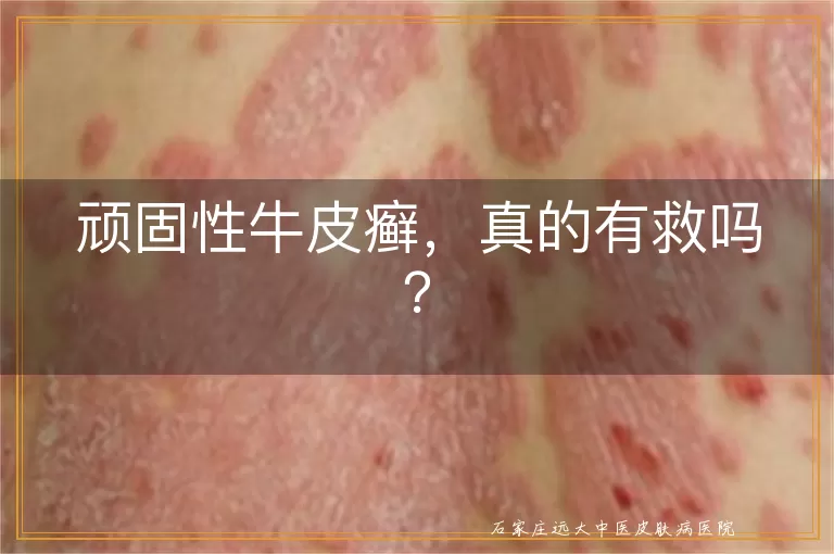 顽固性牛皮癣，真的有救吗？