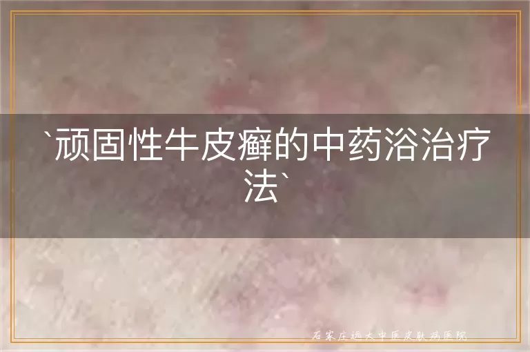 顽固性牛皮癣的中药浴治疗法