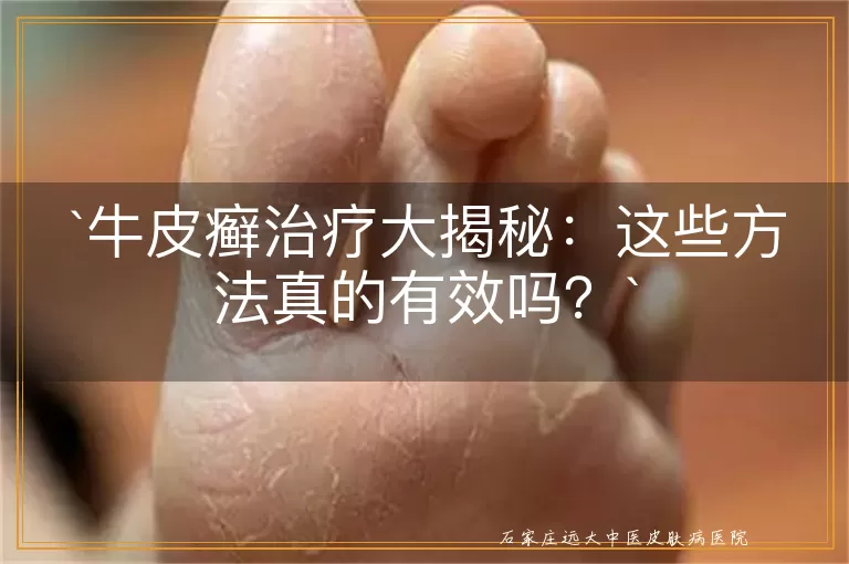 牛皮癣治疗大揭秘：这些方法真的有效吗？