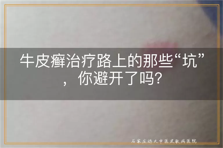 牛皮癣治疗路上的那些“坑”，你避开了吗？