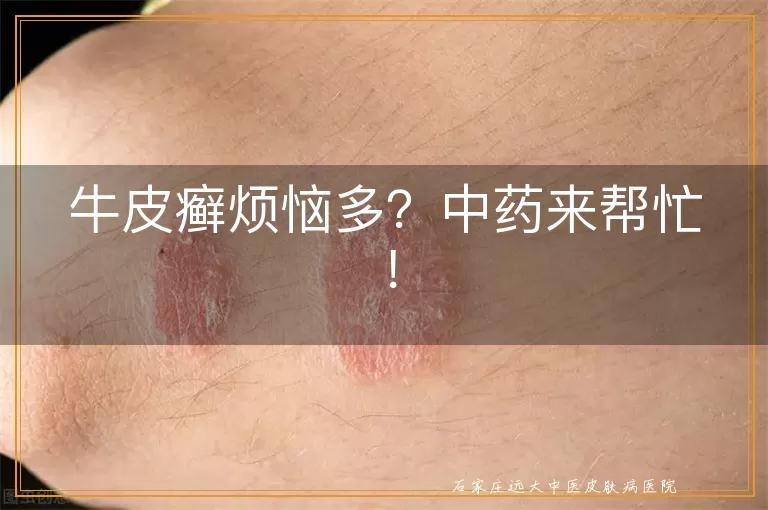 牛皮癣烦恼多？中药来帮忙！