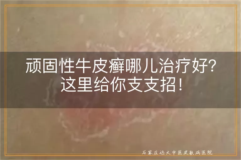 顽固性牛皮癣哪儿治疗好？这里给你支支招！