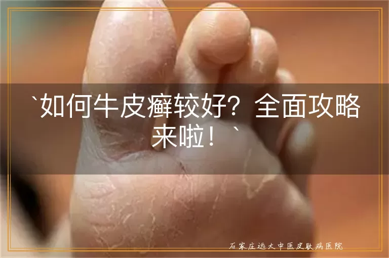 如何牛皮癣较好？全面攻略来啦！