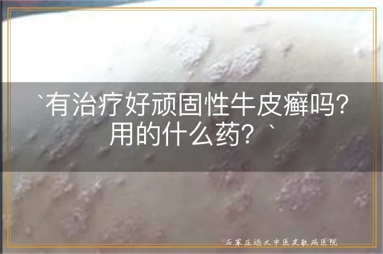 有治疗好顽固性牛皮癣吗？用的什么药？