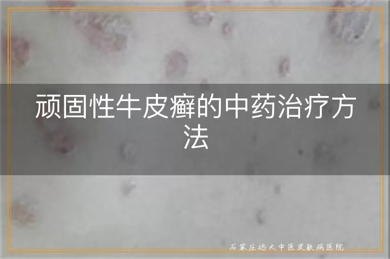 顽固性牛皮癣的中药治疗方法