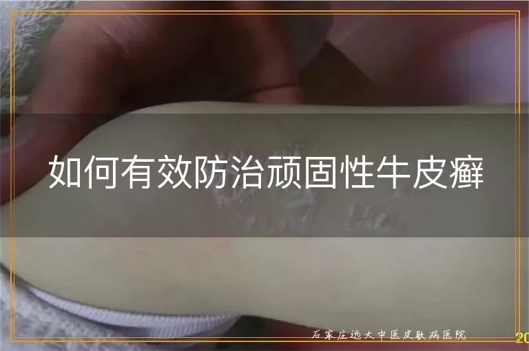 如何有效防治顽固性牛皮癣