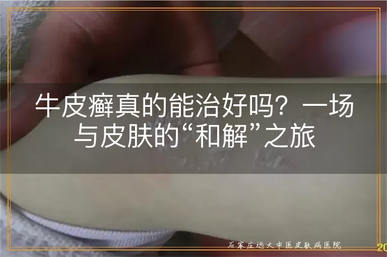 牛皮癣真的能治好吗？一场与皮肤的“和解”之旅