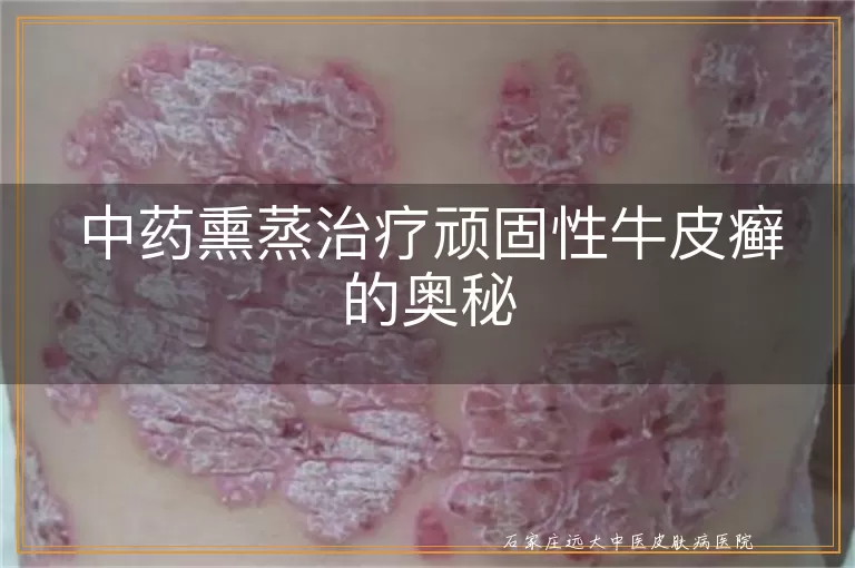 中药熏蒸治疗顽固性牛皮癣的奥秘