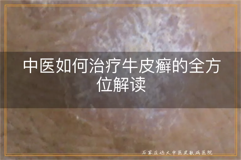 中医如何治疗牛皮癣的全方位解读