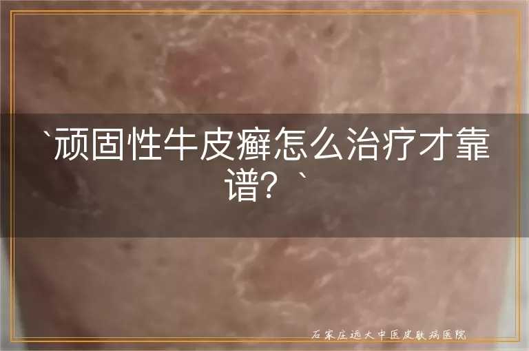 顽固性牛皮癣怎么治疗才靠谱？