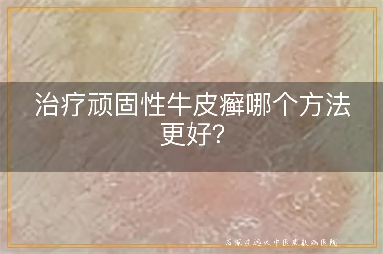 治疗顽固性牛皮癣哪个方法更好？