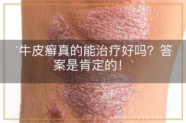 牛皮癣真的能治疗好吗？答案是肯定的！