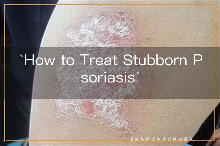 How to Treat Stubborn Psoriasis