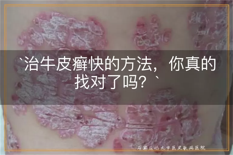 治牛皮癣快的方法，你真的找对了吗？