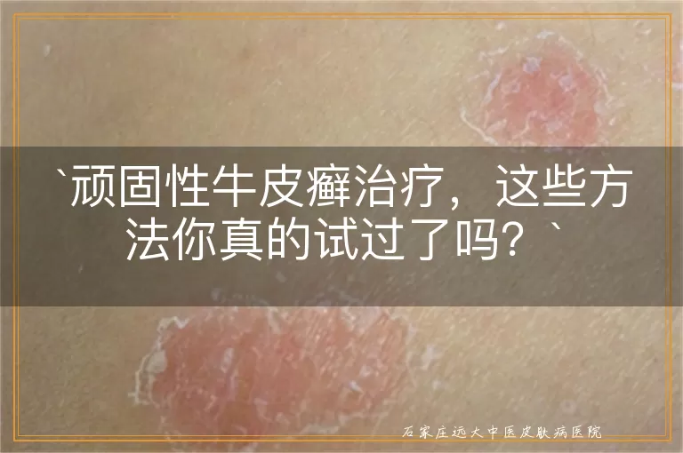 顽固性牛皮癣治疗，这些方法你真的试过了吗？