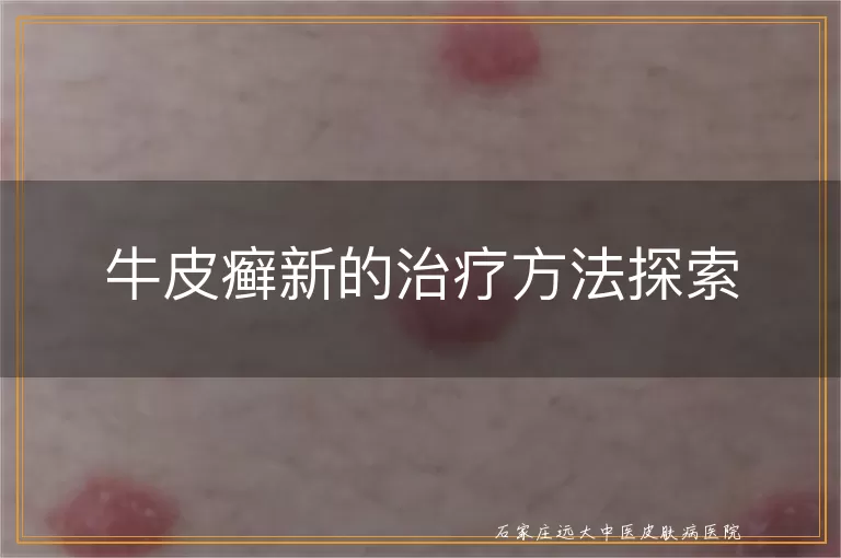 牛皮癣新的治疗方法探索