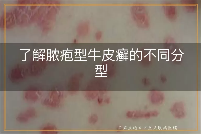 了解脓疱型牛皮癣的不同分型